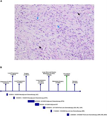 Case Report: Analysis of Plasma Extracellular Vesicles in a Triple Negative Spindle-Cell Metaplastic Breast Cancer Patient